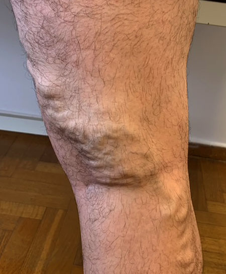 fleviki_aneparkeia-kirsoi